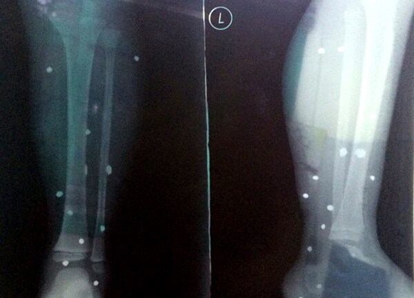 Trúng loạt đạn súng hoa cải, bé 4 tuổi nhập viện