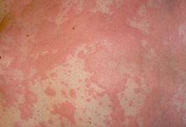Hỏi đáp về bệnh dị ứng và cách chữa trị