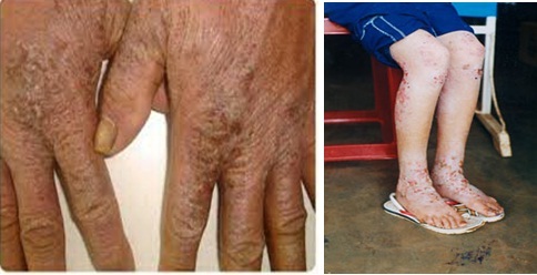 Đi tìm nơi chữa bệnh chàm.