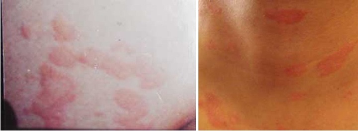 Cần Biết Về Bệnh Ngứa Dị ứng - Mề Đay
