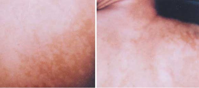 Hỏi Đáp Về Bệnh Lang Ben