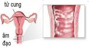 Bệnh khó nói và cách điều trị ở chị em phụ nữ