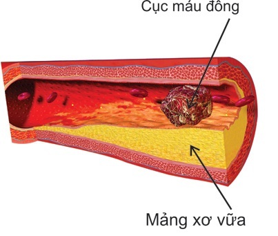 Cứu tinh cho bệnh nhân đau tim