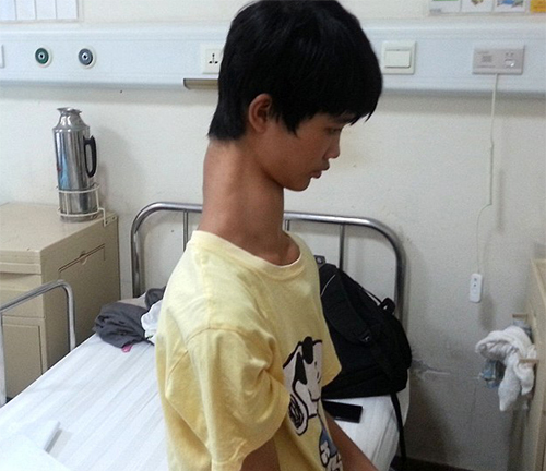 Thiếu niên Trung Quốc khổ sở vì có cổ dài bất thường