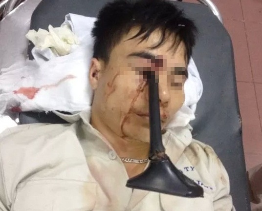 Cầm ô đi xe máy, thanh niên bị cán gương đâm xuyên mắt