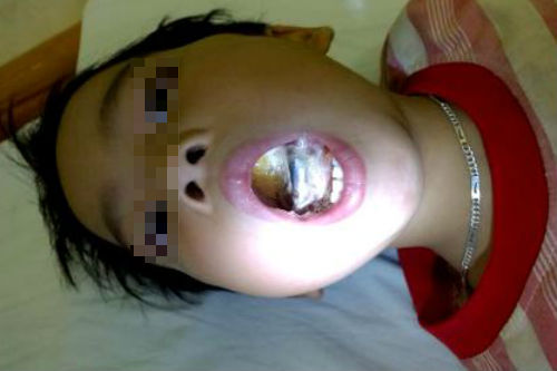 Bé 6 tuổi cháy lưỡi vì ngậm phích cắm điện