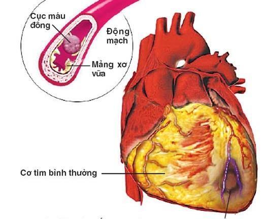Xơ vữa động mạch: Nguyên nhân chính gây đột quỵ