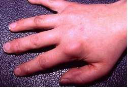 Viêm khớp dạng thấp và các phương pháp điều trị