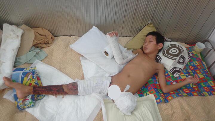 Cậu bé mồ côi 11 tuổi bị xe tải nghiền đứt lìa chân cầu cứu