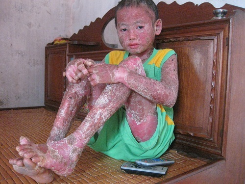 Cảm thương cháu bé mắc bệnh vảy nến thể mủ