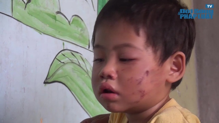 Bé gái 2 tuổi bị bạo hành dã man