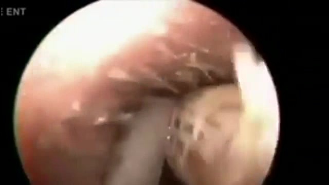 Kinh hãi khi phát hiện dế khổng lồ làm tổ trong tai người