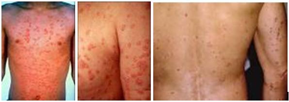 Hỏi và đáp về bệnh vẩy nến thể giọt