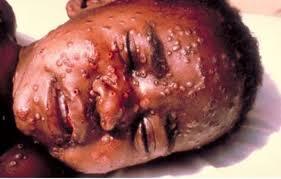 Những điều cần biết về đại dịch Ebola đe dọa thế giới