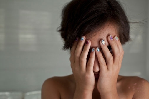 Xua tan tâm lý tự ti do vẩy nến