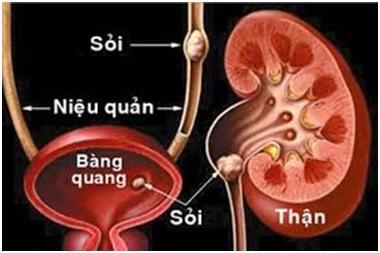 Điều trị sỏi thận sỏi mật bằng Kim Nguyên Tan Sỏi Hoàn
