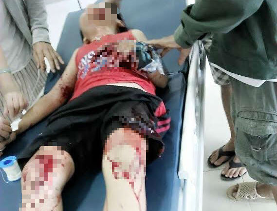 Lựu đạn nhựa phát nổ, 2 cháu bé nhập viện cấp cứu