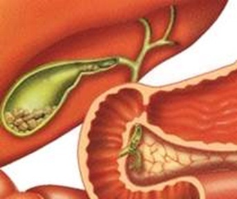 Kim Nguyên Tan Sỏi Hoàn điều trị sỏi thận sỏi mật