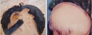 Hỏi đáp về chứng rụng tóc