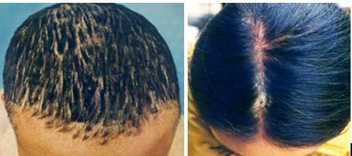 Hỏi đáp bệnh á sừng da đầu chữa ở đâu?