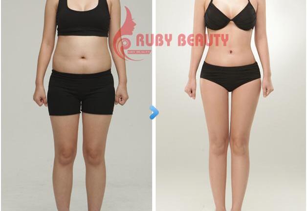 Thực hư hút mỡ không phẫu thuật