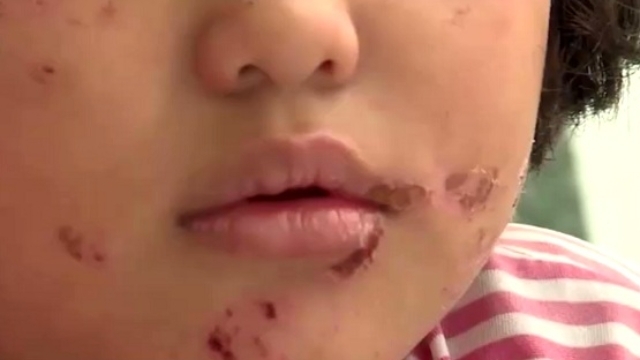 Video: Bé gái 6 tuổi bị cha ruột bạo hành, dùng lửa đốt khắp người