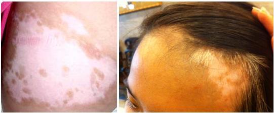 Bệnh bạch biến và cách điều trị ở Bảo Thanh Đường