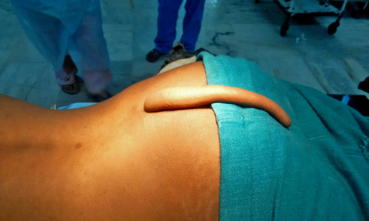 Phẫu thuật cắt bỏ chiếc đuôi dài hơn 20cm của chàng trai