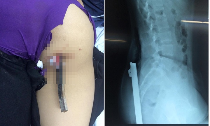 Nữ sinh nhập viện vì bị thanh sắt từ xe 3 bánh đâm vào người