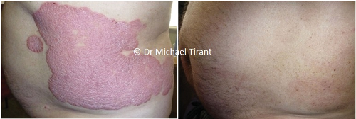 Nghiên cứu mở đa trung tâm về sản phẩm Dr Michaels thảo dược điều trị vảy nến