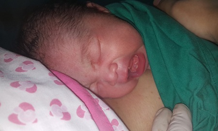 Kỳ lạ bé gái vừa sinh ra đã có 2 răng cửa ở TP.HCM