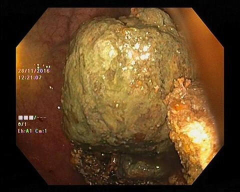 Ăn hồng ngâm nhai không kỹ, nữ bệnh nhân có 4 khối bã thức ăn to như quả trứng
