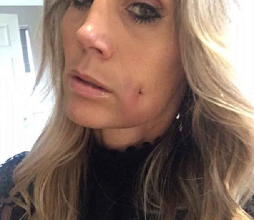 Người phụ nữ chi hơn 37 triệu làm má lúm đồng tiền