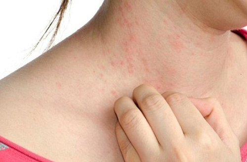 Mách bạn các cách chữa bệnh ngứa vào mùa đông hiệu quả