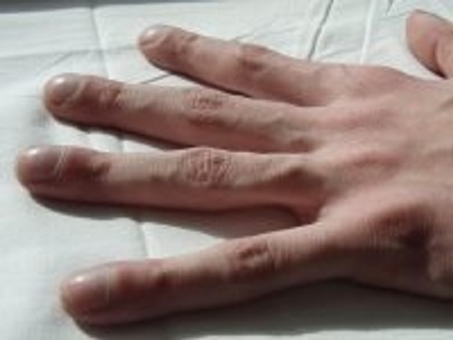 Cảnh báo các bệnh nguy hiểm qua dấu hiệu bất thường ở móng tay