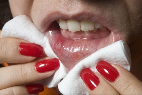 Những cách chữa nhiệt miệng cực kì đơn giản ít ai ngờ