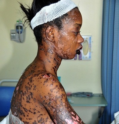 Dị ứng thuốc kháng sinh, cô gái xinh đẹp bị lở loét, cháy đen 90% cơ thể