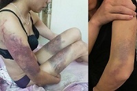 Thông tin mới nhất vụ cô gái bị bạn trai nhốt, đánh đập bằng gậy 