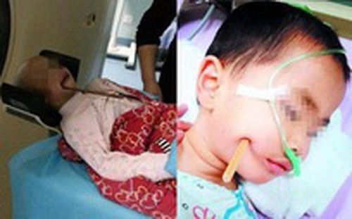 Bé gái 3 tuổi ngã cầu thang bị đũa đâm thọc sâu vào não sống sót diệu kỳ