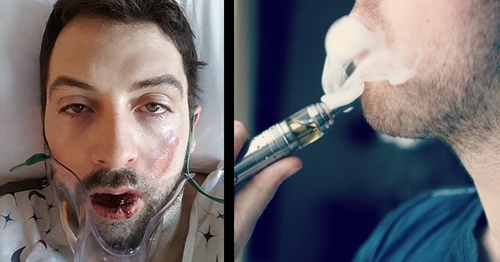 Mất gần hết hàm răng kèm bỏng nặng vì thuốc lá điện tử