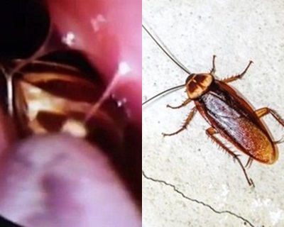 Kinh hoàng gián chui vào trong đầu người mà vẫn còn sống