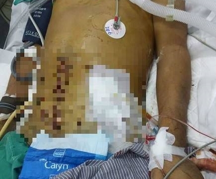 Bắc Giang: Tử vong sau khi mổ thoát vị bẹn, gia đình tố bệnh viện tắc trách?