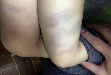 Sa thải cô giáo mầm non đánh bầm tím đùi trẻ