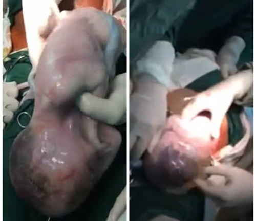 3 ca sinh con nằm trong bọc ối hy hữu tại Việt Nam khiến bác sĩ ngỡ ngàng