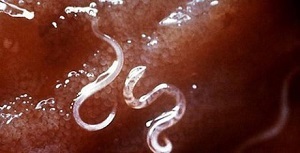 Người đàn ông bị giun đũa chó mèo làm tổ trong não ở Hải Phòng