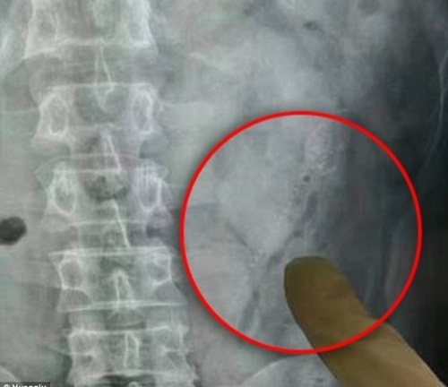 Bợm nhậu suýt chết vì 