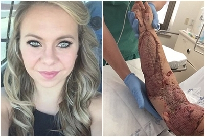 Bà mẹ trẻ chịu đau đớn “chết đi sống lại” trong ca phẫu thuật nối liền cánh tay