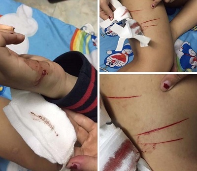 Nữ sinh lớp 11 trình báo bị rạch tay trên đường đi học về