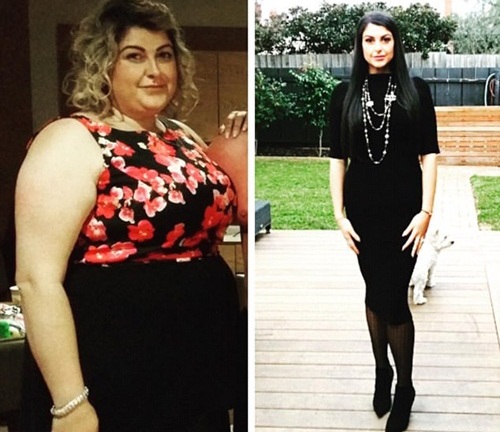 Không thể sinh con vì quá béo, người phụ nữ quyết định phẫu thuật dạ dày