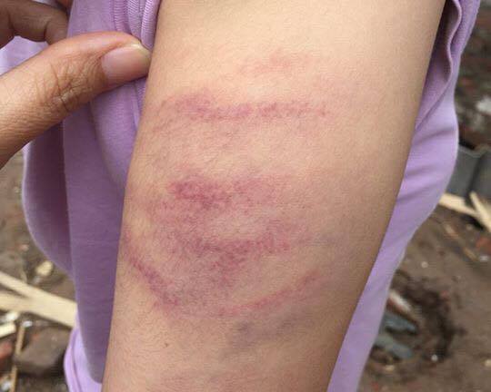 Vụ cô giáo đánh học sinh bầm tím tay: Đình chỉ công tác giáo viên